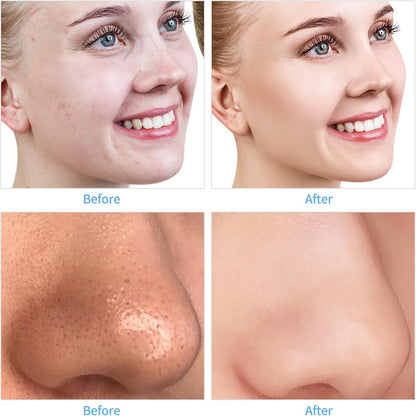 Diamond Professional Microdermabrasion Machine - Blackhead Remover & Facial Care Tool