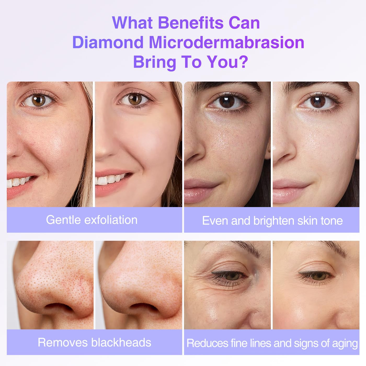 Diamond Dermabrasion Head, 6 PCS Dermabrasion Replacement Tips, Professional Microdermabrasion Accessories for Microdermabrasion Machine